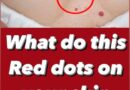 ST, What to do if you have red spots on different parts of your body and if they should bother you?